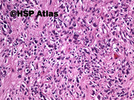 8. Gastrointestinal stromal tumor (GIST - epithelioid cell type), 20x