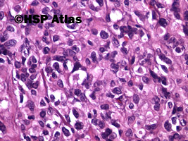 9. Nowotwór podścieliskowy przewodu pokarmowego - typ epitelioidny [gastrointestinal stromal tumor (GIST) - epithelioid cell type], 40x