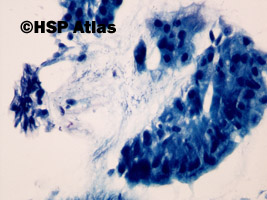 4. Przewlekłe aktywne zapalenie żołądka (Helicobacter gastritis), Giemsa, 40x