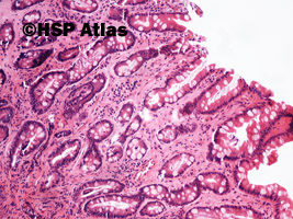 1. Przewlekłe zanikowe zapalenie błony śluzowej żołądka z metaplazją jelitową (chronic atrophic gastritis with intestinal metaplasia), 10x