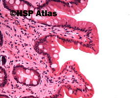 3. Przewlekłe zanikowe zapalenie błony śluzowej żołądka z metaplazją jelitową (chronic atrophic gastritis with intestinal metaplasia), 20x