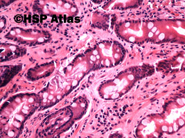 4. Przewlekłe zanikowe zapalenie błony śluzowej żołądka z metaplazją jelitową (chronic atrophic gastritis with intestinal metaplasia), 20x