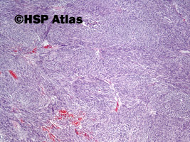 1. Nowotwór podścieliskowy przewodu pokarmowego - typ wrzecionowatokomórkowy [gastrointestinal stromal tumor (GIST) - spindle cell type], 4x