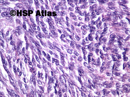 10. Nowotwór podścieliskowy przewodu pokarmowego - typ wrzecionowatokomórkowy [gastrointestinal stromal tumor (GIST) - spindle cell type], 40x