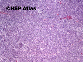 2. Nowotwór podścieliskowy przewodu pokarmowego - typ wrzecionowatokomórkowy [gastrointestinal stromal tumor (GIST) - spindle cell type], 4x