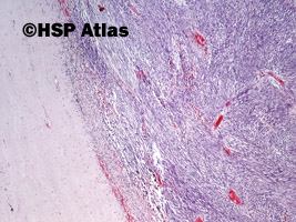 3. Nowotwór podścieliskowy przewodu pokarmowego - typ wrzecionowatokomórkowy [gastrointestinal stromal tumor (GIST) - spindle cell type], 4x