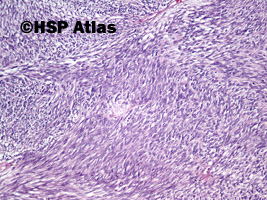 4. Nowotwór podścieliskowy przewodu pokarmowego - typ wrzecionowatokomórkowy [gastrointestinal stromal tumor (GIST) - spindle cell type], 10x
