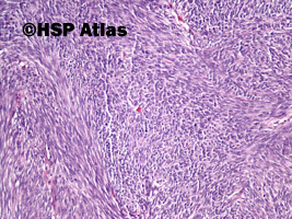 5. Nowotwór podścieliskowy przewodu pokarmowego - typ wrzecionowatokomórkowy [gastrointestinal stromal tumor (GIST) - spindle cell type], 10x
