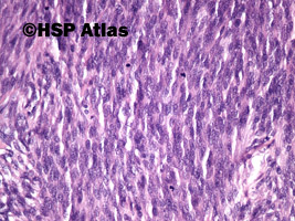 7. Nowotwór podścieliskowy przewodu pokarmowego - typ wrzecionowatokomórkowy [gastrointestinal stromal tumor (GIST) - spindle cell type], 20x