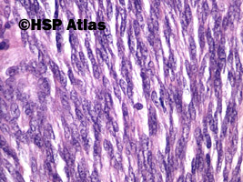 9. Nowotwór podścieliskowy przewodu pokarmowego - typ wrzecionowatokomórkowy [gastrointestinal stromal tumor (GIST) - spindle cell type], 40x