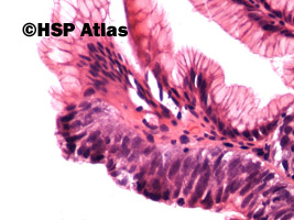 4. Wewnątrznabłonkowa neoplazja (dysplazja) dużego stopnia [high grade intraepithelial neoplasia (dysplasia)], 40x