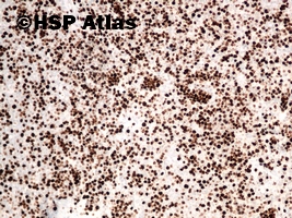 14. Chłoniak MALT (MALT lymphoma), Ki-67, 10x
