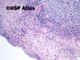1. Czerniak złośliwy (malignant melanoma), wrzód żołądka, 10x