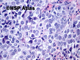 4. Czerniak złośliwy (malignant melanoma), 40x