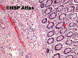 1. Rak gruczołowy, typ rozlany (sygnetowatokomórkowy) [adenocarcinoma, diffuse type (signet ring cell carcinoma)], 4x