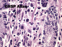 10. Rak gruczołowy, typ rozlany (sygnetowatokomórkowy) [adenocarcinoma, diffuse type (signet ring cell carcinoma)], 40x