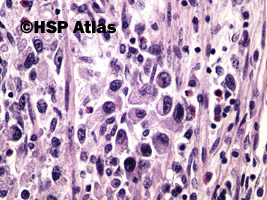 11. Rak gruczołowy, typ rozlany (sygnetowatokomórkowy) [adenocarcinoma, diffuse type (signet ring cell carcinoma)], 40x