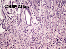 2. Rak gruczołowy, typ rozlany (sygnetowatokomórkowy) [adenocarcinoma, diffuse type (signet ring cell carcinoma)], 10x