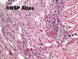 4. Rak gruczołowy, typ rozlany (sygnetowatokomórkowy) [adenocarcinoma, diffuse type (signet ring cell carcinoma)], 10x