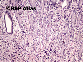 5. Rak gruczołowy, typ rozlany (sygnetowatokomórkowy) [adenocarcinoma, diffuse type (signet ring cell carcinoma)], 10x