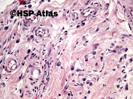 6. Rak gruczołowy, typ rozlany (sygnetowatokomórkowy) [adenocarcinoma, diffuse type (signet ring cell carcinoma)], 20x
