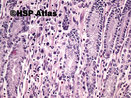 7. Rak gruczołowy, typ rozlany (sygnetowatokomórkowy) [adenocarcinoma, diffuse type (signet ring cell carcinoma)], 20x