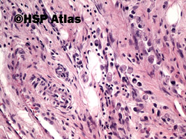 8. Rak gruczołowy, typ rozlany (sygnetowatokomórkowy) [adenocarcinoma, diffuse type (signet ring cell carcinoma)], 20x