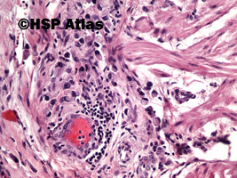 9. Rak gruczołowy, typ rozlany (sygnetowatokomórkowy) [adenocarcinoma, diffuse type (signet ring cell carcinoma)], 20x