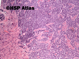 1. Neuroendocrine adenoma of the middle ear, 4x