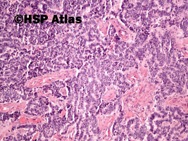 2. Neuroendocrine adenoma of the middle ear, 10x