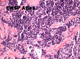 7. Neuroendocrine adenoma of the middle ear, 20x