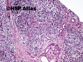 3. Mięśniakomięsak prążkowanokomórkowy, typ zarodkowy (embryonal rhabdomyosarcoma), 10x