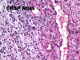 5. Mięśniakomięsak prążkowanokomórkowy, typ zarodkowy (embryonal rhabdomyosarcoma), 20x