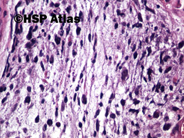 7. Mięśniakomięsak prążkowanokomórkowy, typ zarodkowy (embryonal rhabdomyosarcoma), 40x