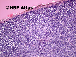2. Malignant melanoma, epithelioid cell type, 10x