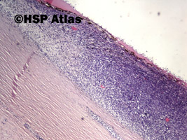 3. Malignant melanoma, epithelioid cell type, 4x