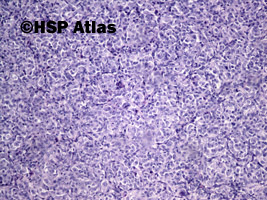 4. Malignant melanoma, epithelioid cell type, 10x
