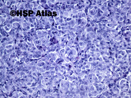 6. Malignant melanoma, epithelioid cell type, 20x