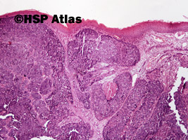 1. Rak płaskonabłonkowy bazaloidny (basaloid squamous cell carcinoma), 4x