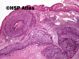 2. Rak płaskonabłonkowy bazaloidny (basaloid squamous cell carcinoma), 4x