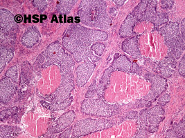 3. Rak płaskonabłonkowy bazaloidny (basaloid squamous cell carcinoma), 4x