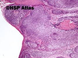 4. Rak płaskonabłonkowy bazaloidny (basaloid squamous cell carcinoma), 4x