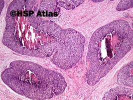 5. Rak płaskonabłonkowy bazaloidny (basaloid squamous cell carcinoma), 4x