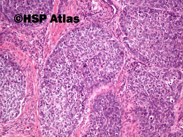 6. Rak płaskonabłonkowy bazaloidny (basaloid squamous cell carcinoma), 10x
