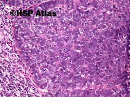 8. Rak płaskonabłonkowy bazaloidny (basaloid squamous cell carcinoma), 20x