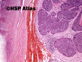 9. Rak płaskonabłonkowy bazaloidny (basaloid squamous cell carcinoma), 4x