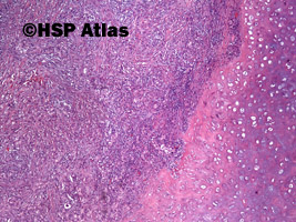 1. Rak wrzecionowatokomórkowy - mięsakorak (spindle cell carcinoma - sarcomatoid carcinoma), 4x
