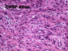 10. Rak wrzecionowatokomórkowy - mięsakorak (spindle cell carcinoma - sarcomatoid carcinoma), 20x