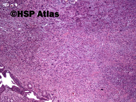 2. Rak wrzecionowatokomórkowy - mięsakorak (spindle cell carcinoma - sarcomatoid carcinoma), 4x