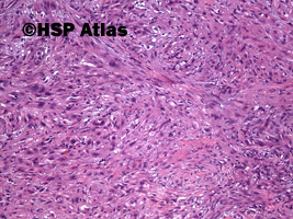 4. Rak wrzecionowatokomórkowy - mięsakorak (spindle cell carcinoma - sarcomatoid carcinoma), 10x